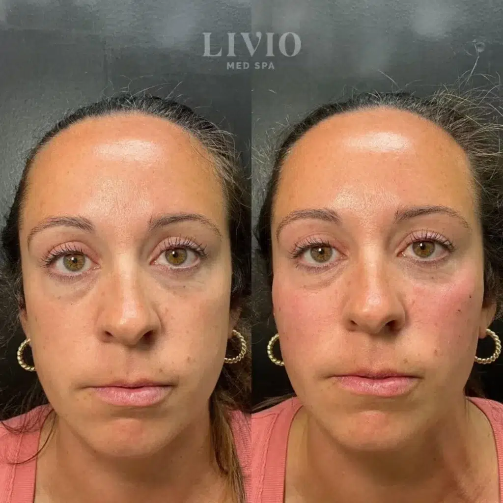 under eye filler before and after photo by livio med spa in cincinnati oh