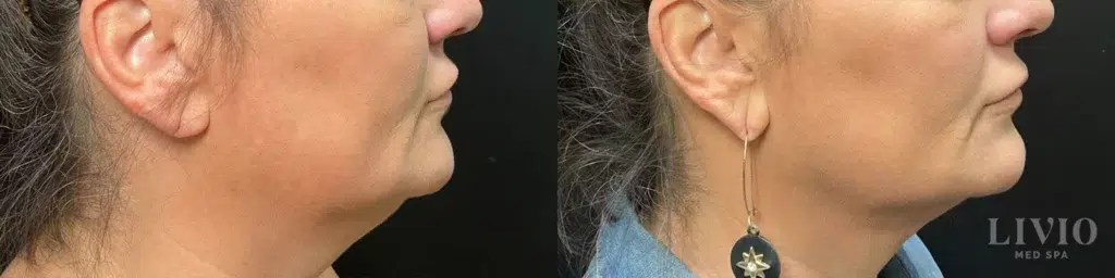 kybella before and after photo by livio med spa in cincinnati oh