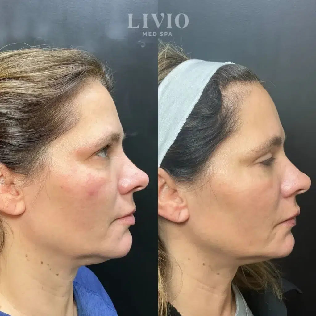 kybella before and after photo by livio med spa in cincinnati oh