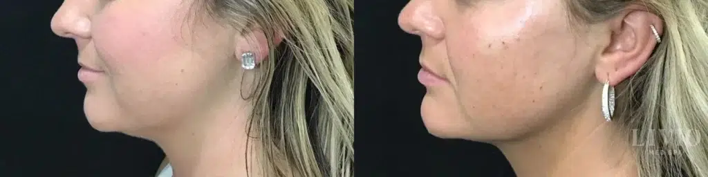 kybella before and after photo by livio med spa in cincinnati oh