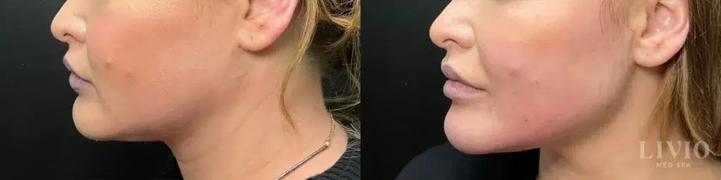 kybella before and after photo by livio med spa in cincinnati oh