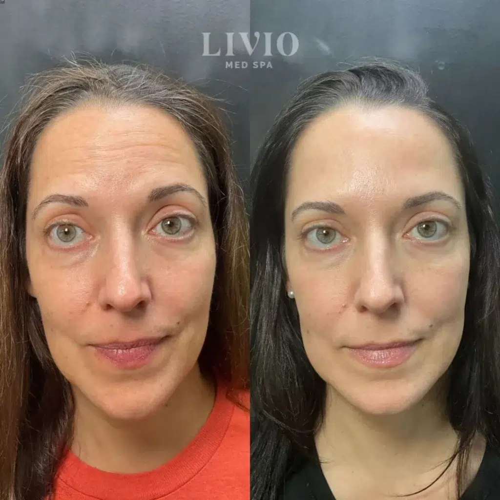 microneedling before and after photo by livio med spa in cincinnati oh