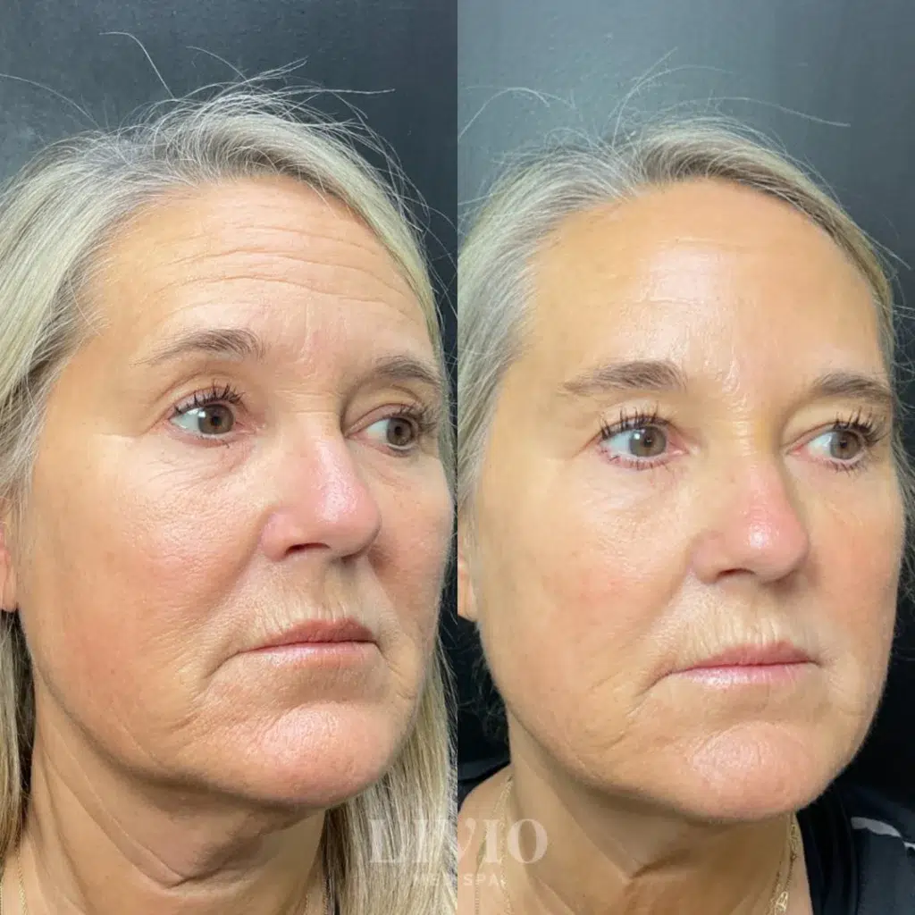 microneedling before and after photo by livio med spa in cincinnati oh