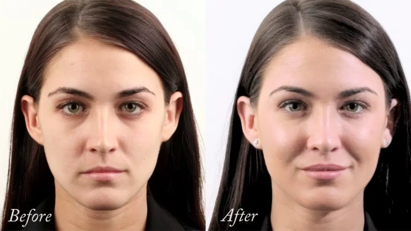 cheek filler before and after