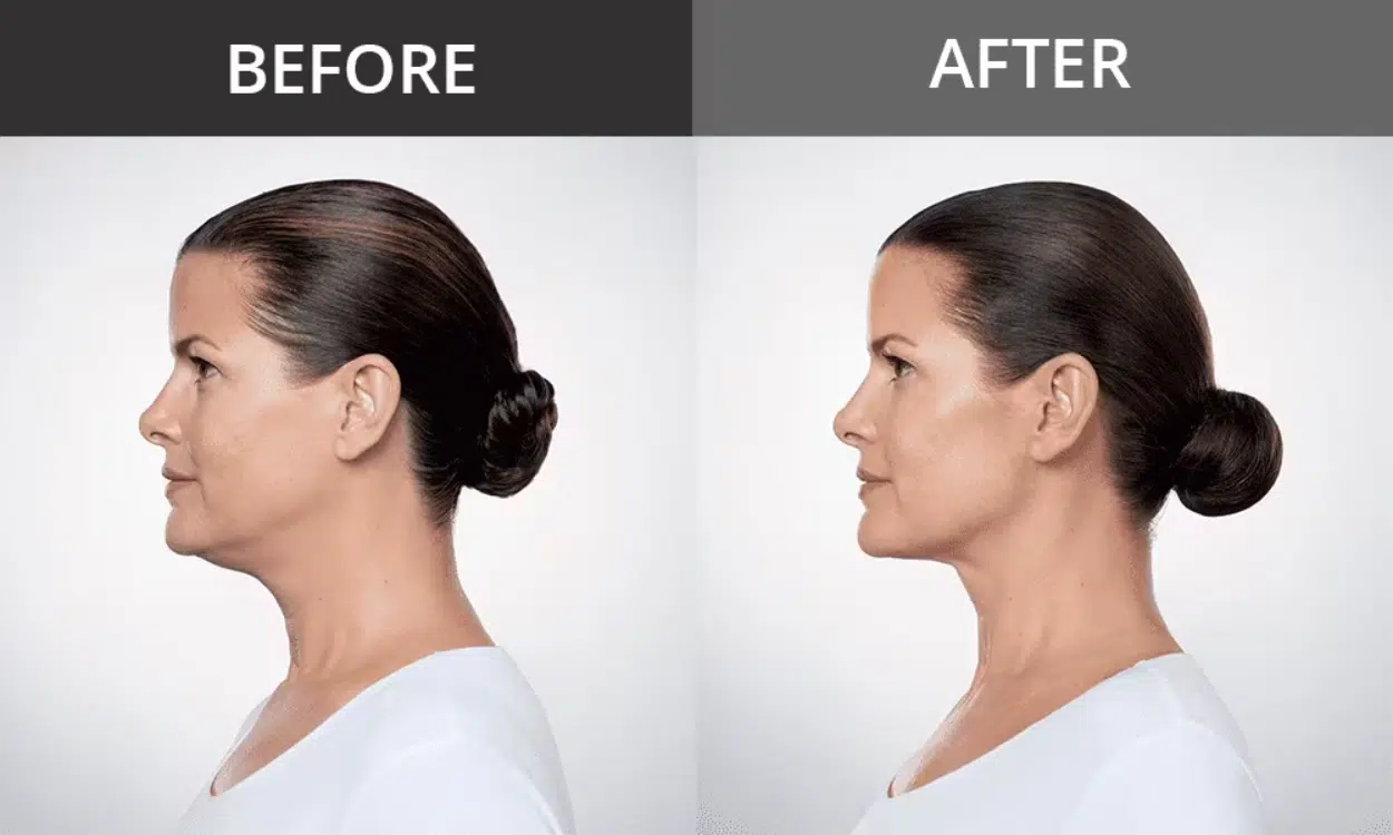 Kybella Double Chin before and after