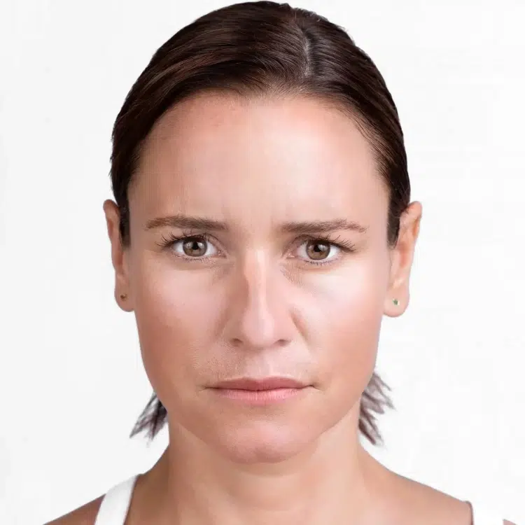 xeomin after photo by livio med spa in cincinnati oh