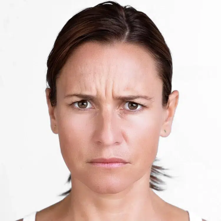 xeomin before photo by livio med spa in cincinnati oh